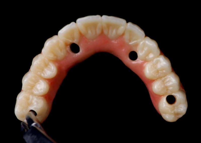 ibar oclusal